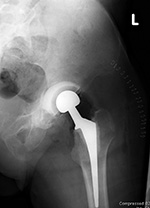 Hip antibiotic laden acetabular spacer